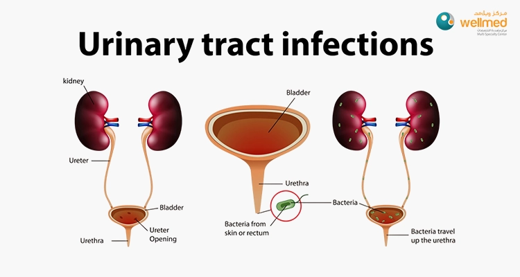 Informative illustration of urinary tract infections